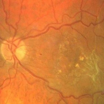 Membrana Epirretiniana Macular